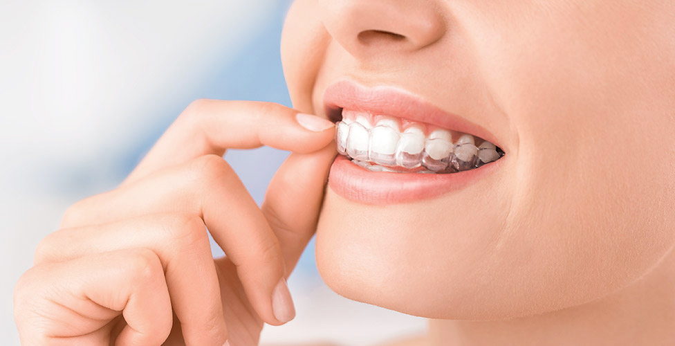 Woman inserting clear aligner